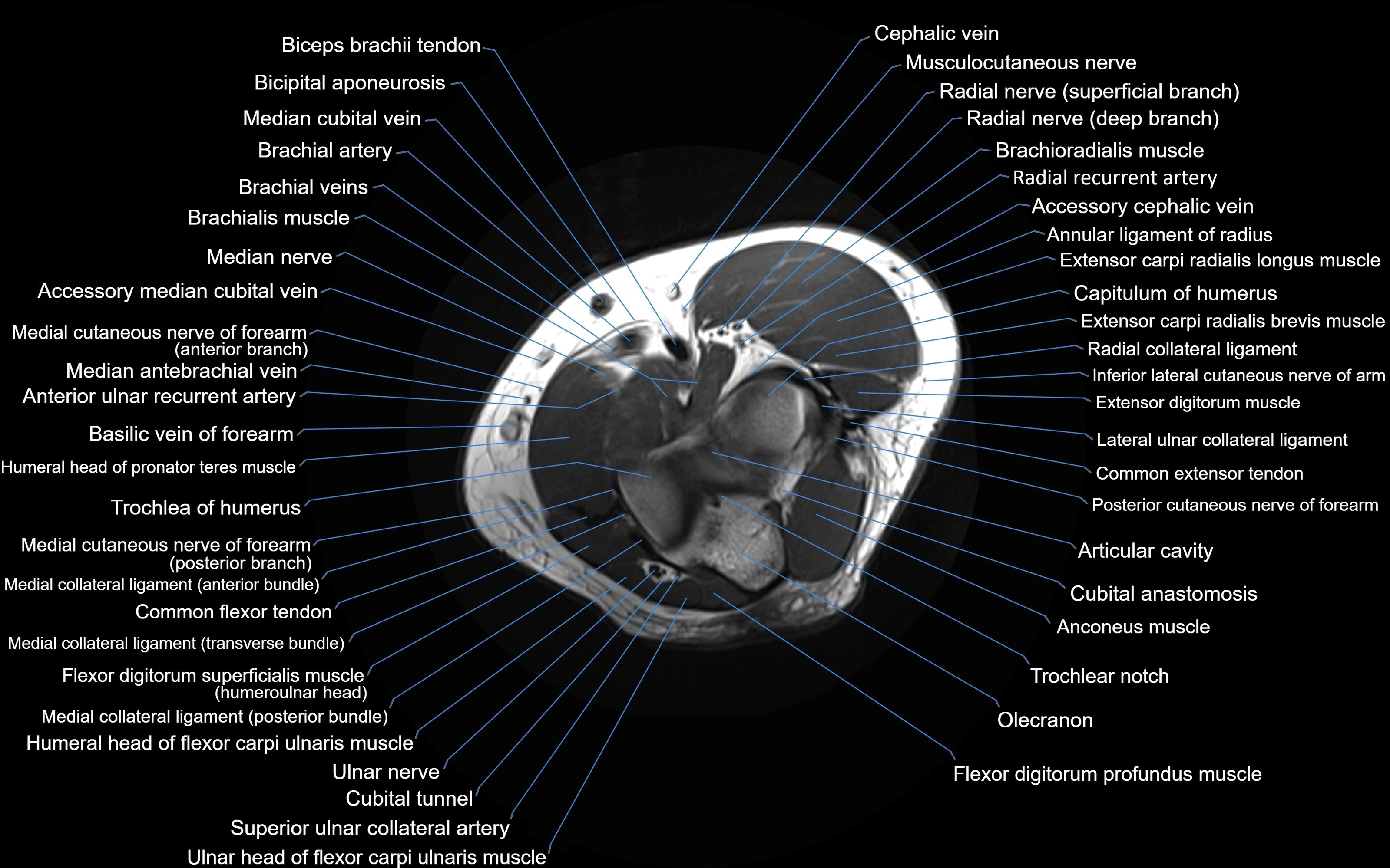 MRI elbow axial cross sectional anatomy 3T  radiology  image-img-00001-00016.webp
